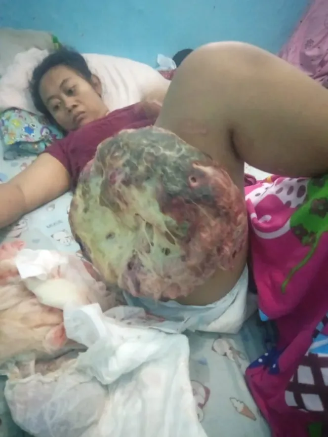 Perjuangan Ninda Parida: Ibu 32 Tahun Penderita Tumor Ganas yang Belum Mendapatkan Penanganan